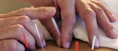acupuntura-recife-1397742765